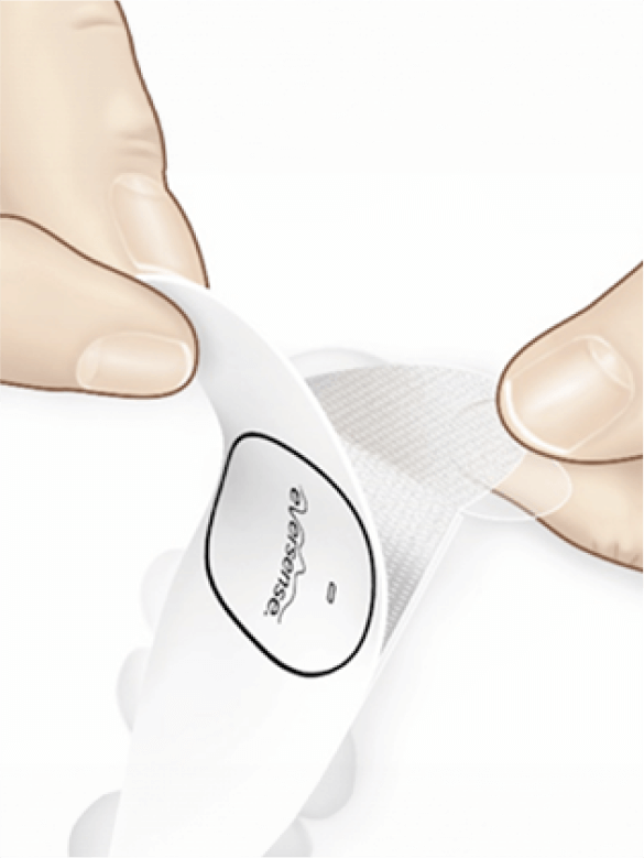 H&auml;nde, die einen atmungsaktiven Klebeverband mit der Aufschrift &bdquo;eversense&ldquo; abziehen, als Vorbereitung f&uuml;r die Verwendung.