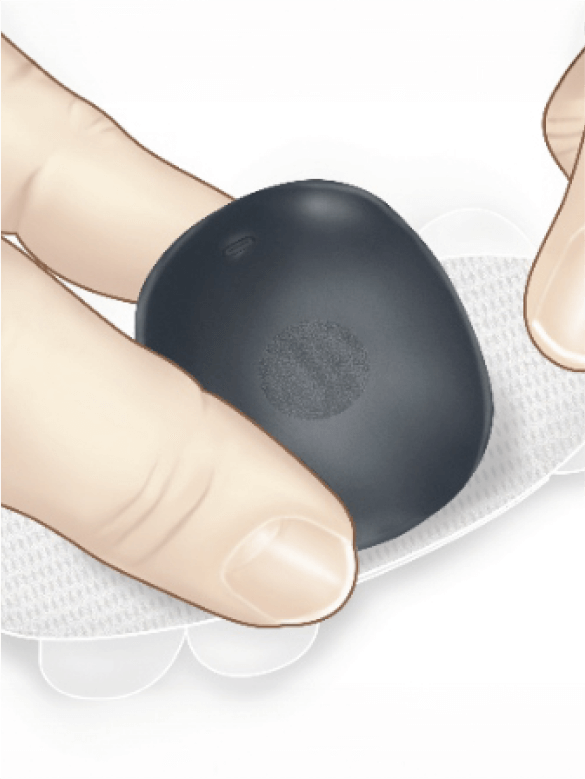Finger dr&uuml;cken den kleinen Eversense CGM Transmitter an.